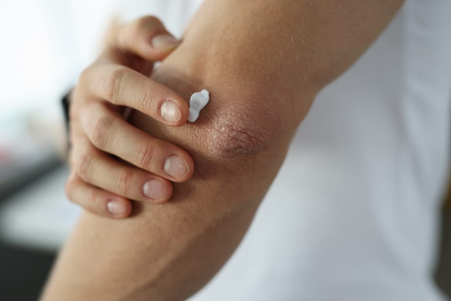 how to get rid of dry skin dry elbows