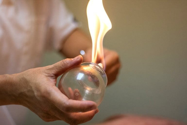 Chinese Medicine doctor using fire to prepare for cupping therapy treatment