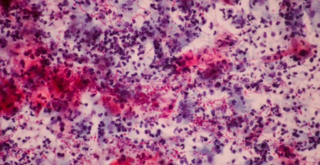 Candida Overgrowth: What You Need To Know – DYWKY