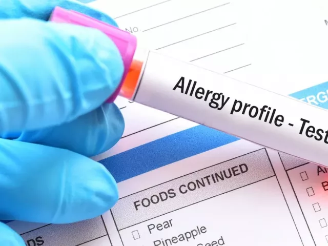 Vial for food sensitivity testing and allergy profile