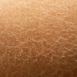 Close-up of dry skin that would benefit from a GLA fatty acid supplement