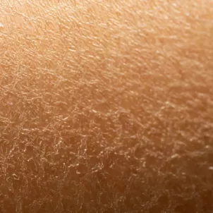 Close-up of dry skin that would benefit from a GLA fatty acid supplement