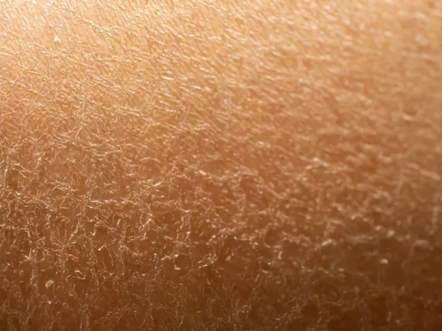 Close-up of dry skin that would benefit from a GLA fatty acid supplement