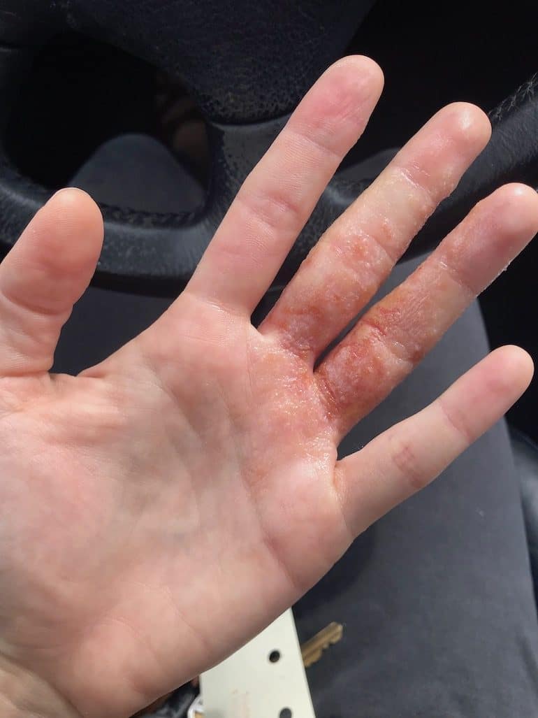 What Finally Helped My Eczema When Doctors Couldn't | HUM Nutrition Blog