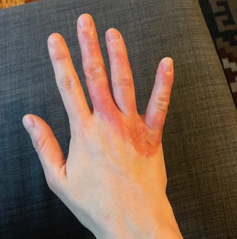 Red Inflamed Eczema on Hands | The Wellnest by HUM Nutrition