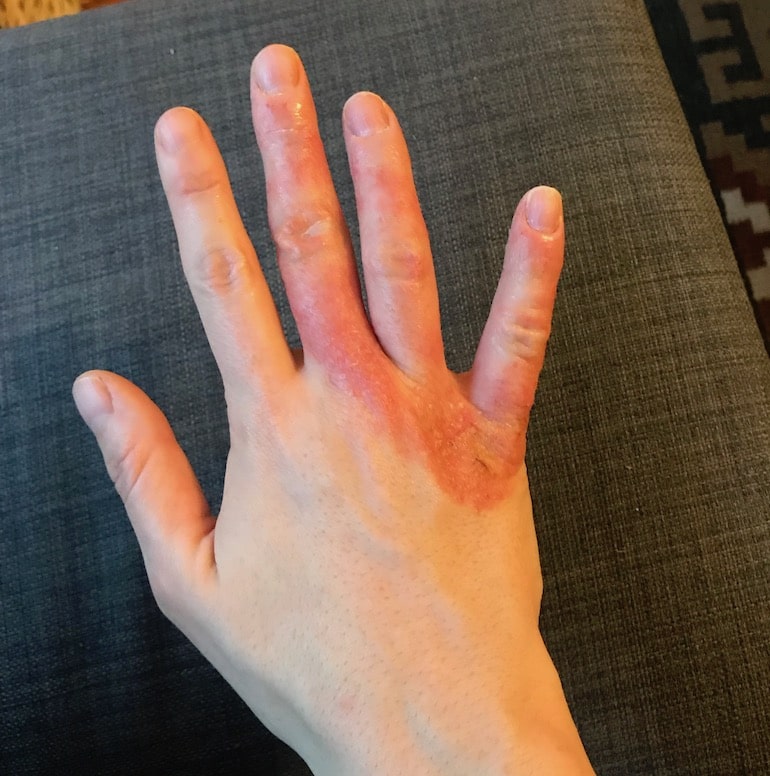 What Finally Helped My Eczema When Doctors Couldn't | HUM Nutrition Blog