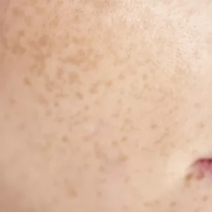 Close up of bare skin during skin fasting test
