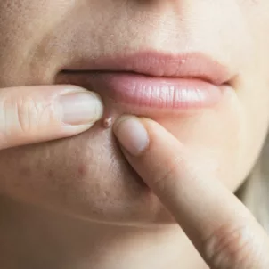 Blonde woman popping a pimple on her chin