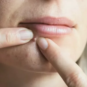 Blonde woman popping a pimple on her chin