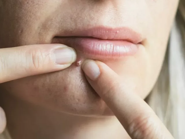 Blonde woman popping a pimple on her chin