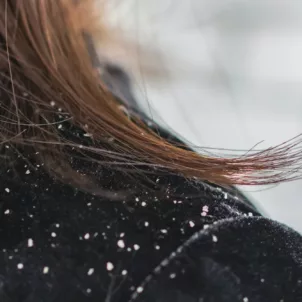 Woman's shoulder with dandruff on her black velvet jacket