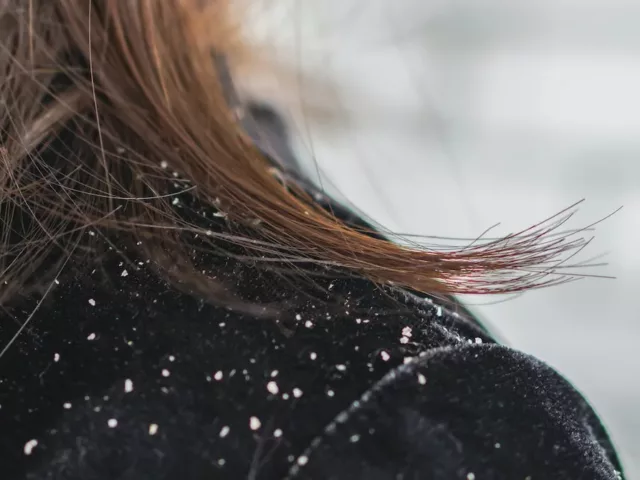 Woman's shoulder with dandruff on her black velvet jacket