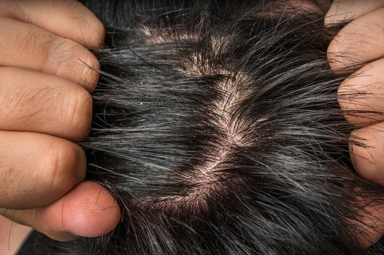 Closeup of man's scalp with dandruff flakes, who needs to learn how to get rid of dandruff naturally