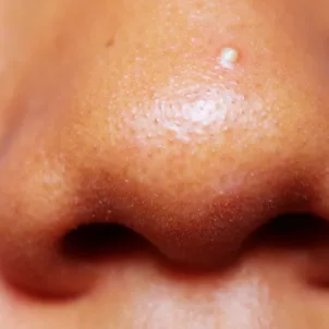 Closeup of woman with a whitehead on her nose, curious if she should dry out her pimple