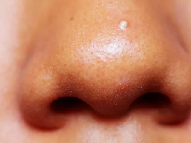 Closeup of woman with a whitehead on her nose, curious if she should dry out her pimple