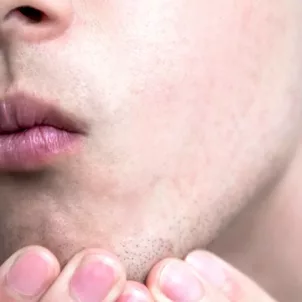 Closeup of man healing his face with the best ingredients for dry skin