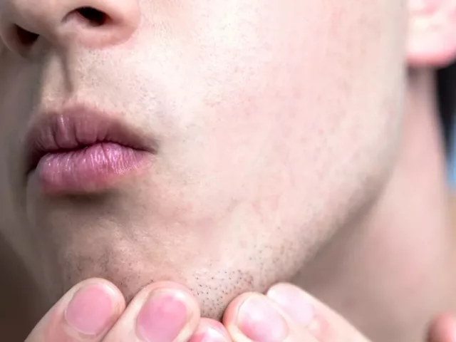 Closeup of man healing his face with the best ingredients for dry skin