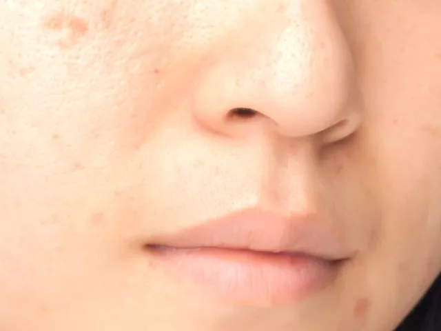Close-up of woman with acne scars, trying to treat and heal them