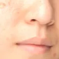 Close-up of woman with acne scars, trying to treat and heal them