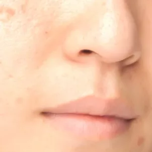 Close-up of woman with acne scars, trying to treat and heal them