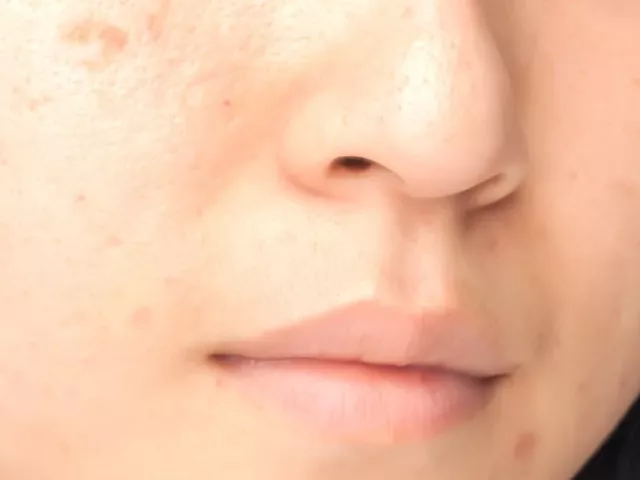 Close-up of woman with acne scars, trying to treat and heal them