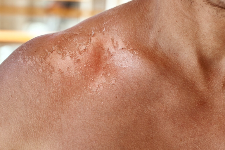 Close-up of man's shoulder with flaky, dry skin due to sunburn