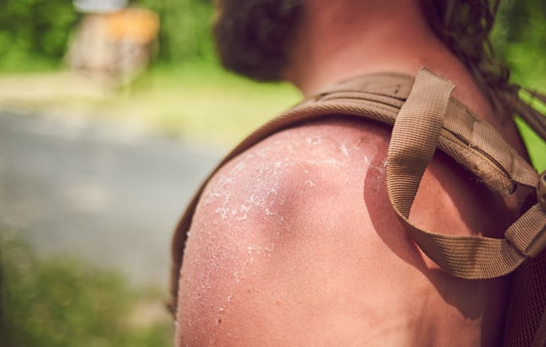 Close up of man with peeling skin and sunburn