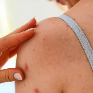 Woman with breakouts on her arm and back trying to discover the causes of body acne