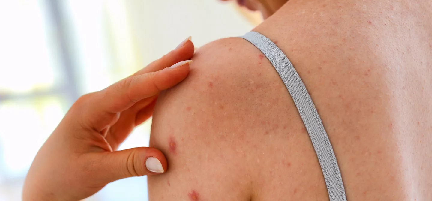 9 Steps to Get Rid of Body Acne ASAP | HUM Nutrition Blog