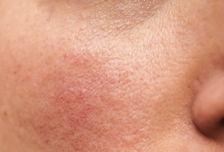 Closeup of person's skin with breakouts and inflammation before using probiotics