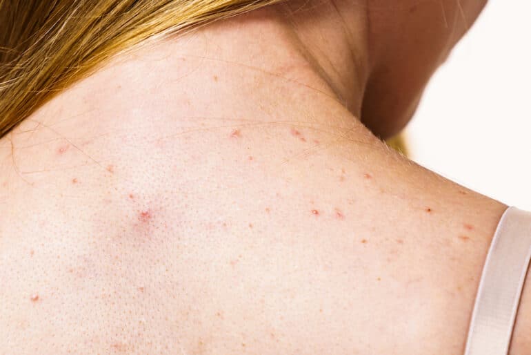 What Is Fungal Acne A Derm Explains What It Looks Like How To Treat fungal-folliculitis-neck