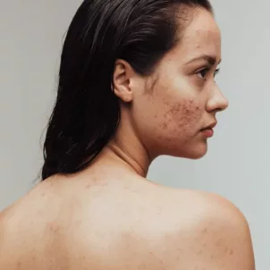 fungal acne woman face and back