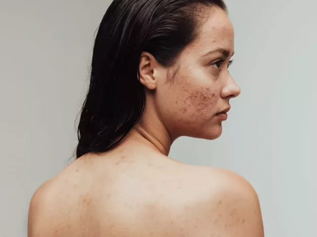 fungal acne woman face and back