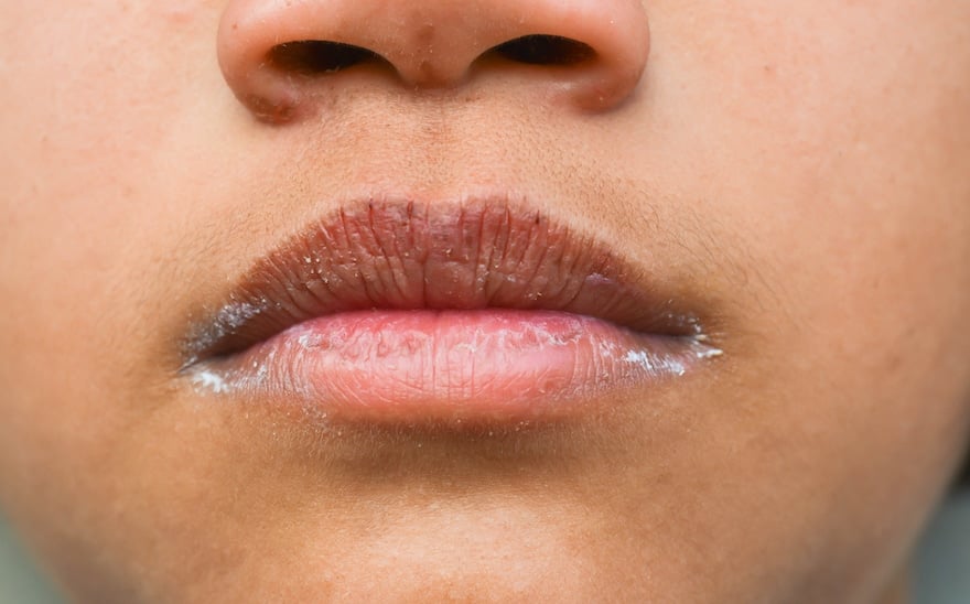 cracked lip corners close up