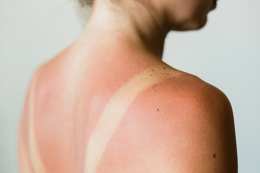 how to get rid of sunburn fast