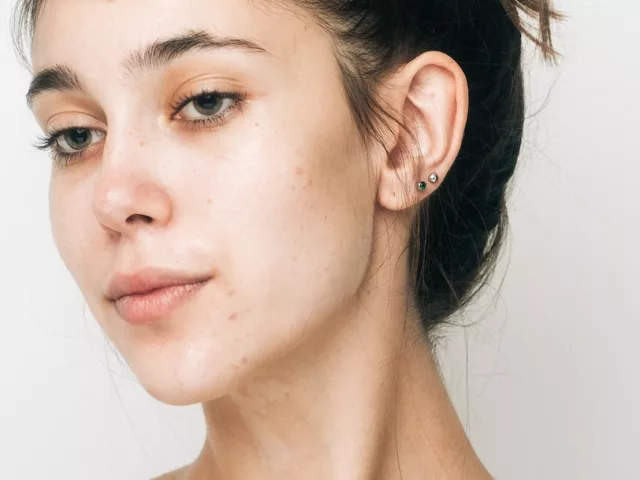 vitamin b acne