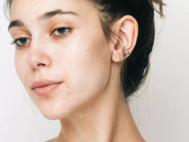 vitamin b acne