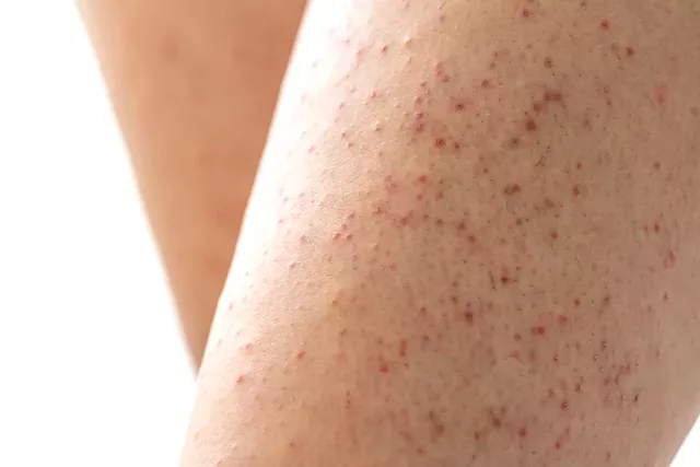 Keratosis pilaris on leg