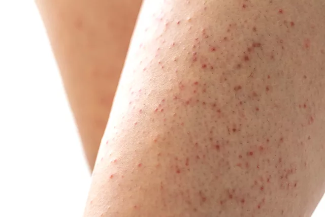 How To Get Rid Of Keratosis Pilaris According To Pros Hum Nutrition Blog