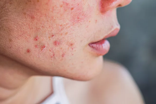 Close-up of woman with acne and rosacea