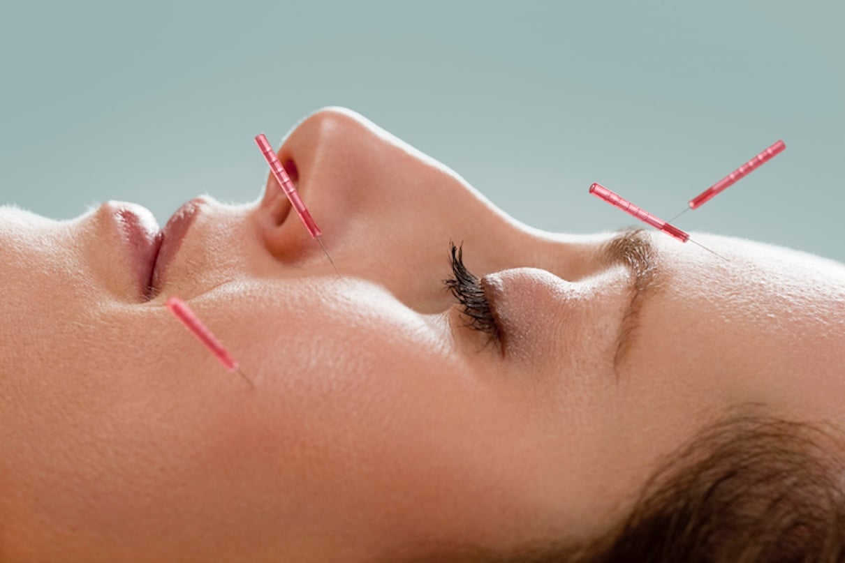 Is Facial Acupuncture the New Botox? Is Facial Acupuncture the New Botox?